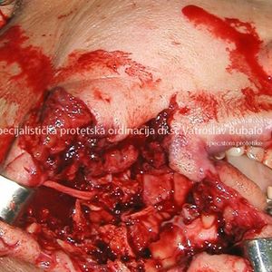 Oral Surgery 1