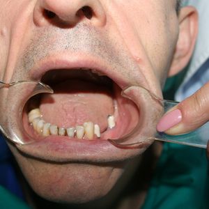 Dental Implants 6
