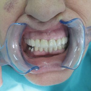 Dental Implants 7