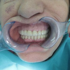 Dental Implants 8