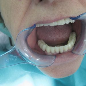 Dental Implants 9