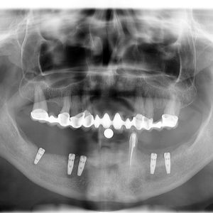Implants 41im