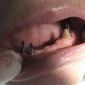 Implants 42im