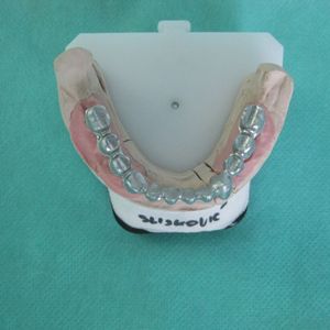 Implants 43im