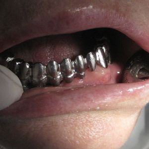 Implants 44im