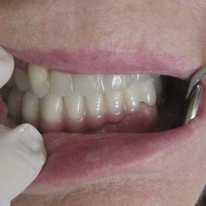 Implants 45im