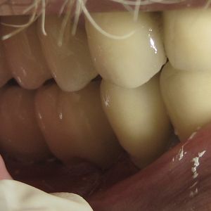 Dental Implants 4