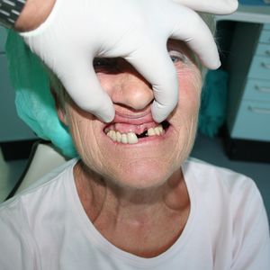 Combination Prosthetics 5