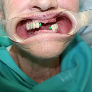 Combination Prosthetics 6