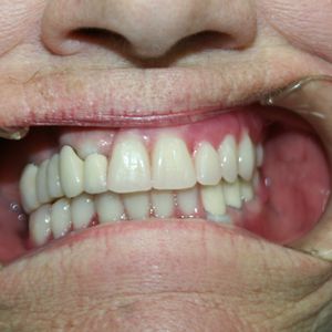Combination Prosthetics 8