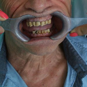 Combination Prosthetics 1