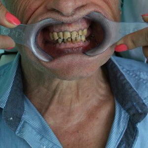 Combination Prosthetics 2