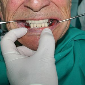 Combination Prosthetics 3