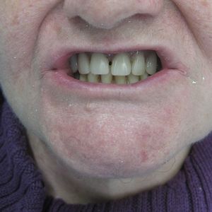 Prostheses 21pr