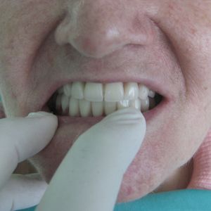Prostheses 22pr