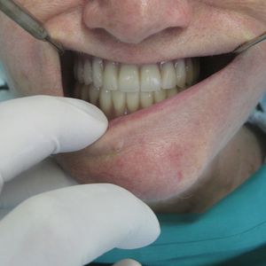 Prostheses 23pr