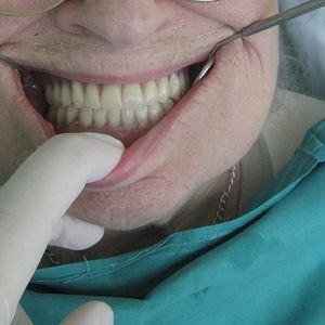 Prostheses 32pr