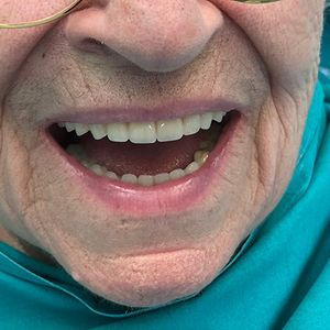 Prostheses 35pr