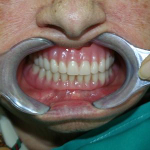 Prostheses 41pr