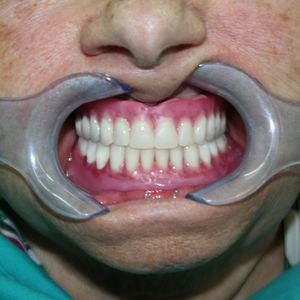 Prostheses 42pr
