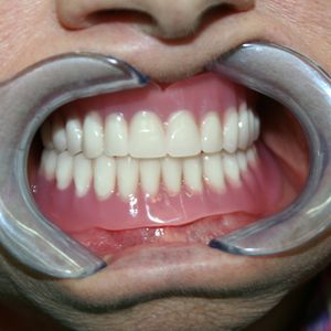 Prostheses 43pr