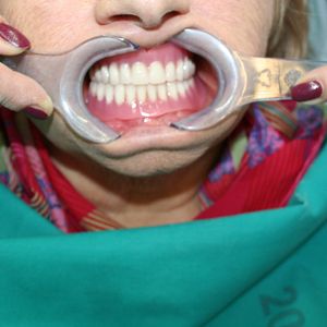 Prostheses 44pr