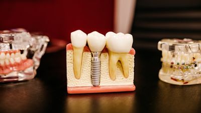 Implants